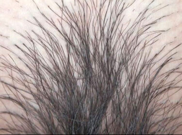 300人のまん毛3｜gat00024